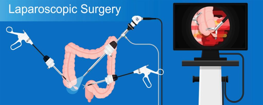 Understanding Laparoscopic Colorectal Surgery: Benefits and Recovery Process
