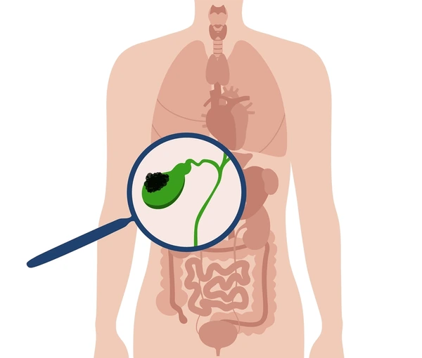 Cholangiocarcinoma