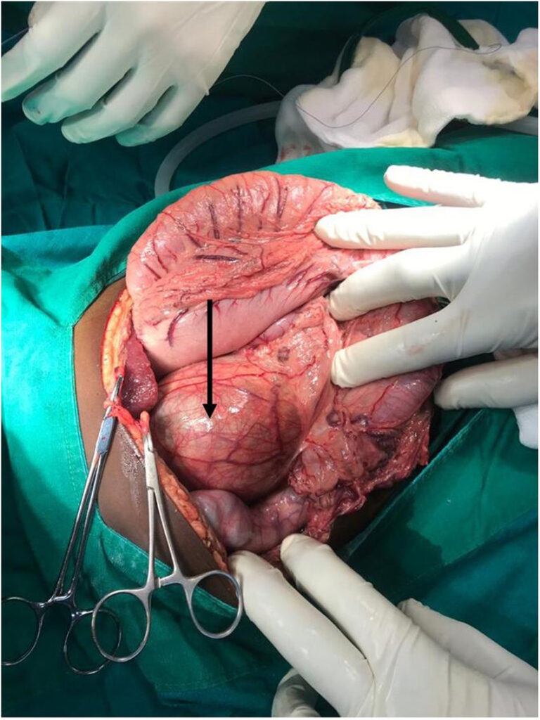 Choledochal Cyst