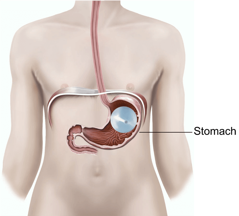 Intra Gastric Balloon Insertion
