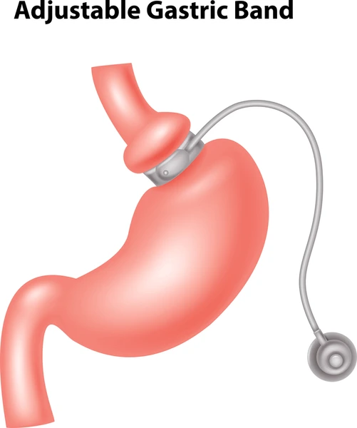 Laparoscopic Adjustable Gastric Banding
