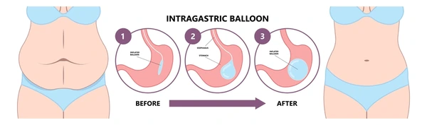 Laparoscopic Banded Roux-en Y Gastric Bypass