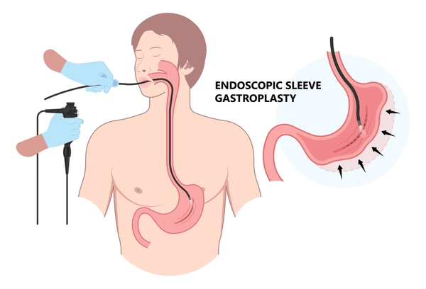 Laparoscopic Banded Roux-en Y Gastric Bypass