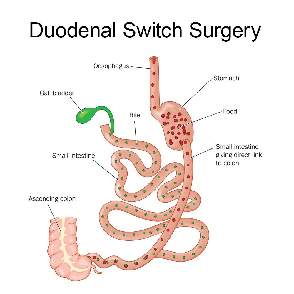 Laparoscopic Duodenal Switch