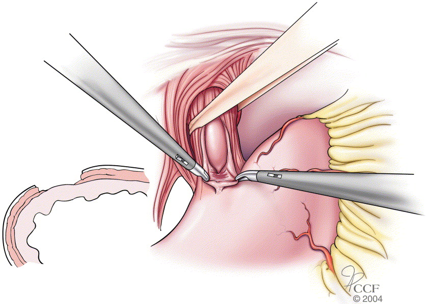 Laparoscopic Heller’s Myotomy