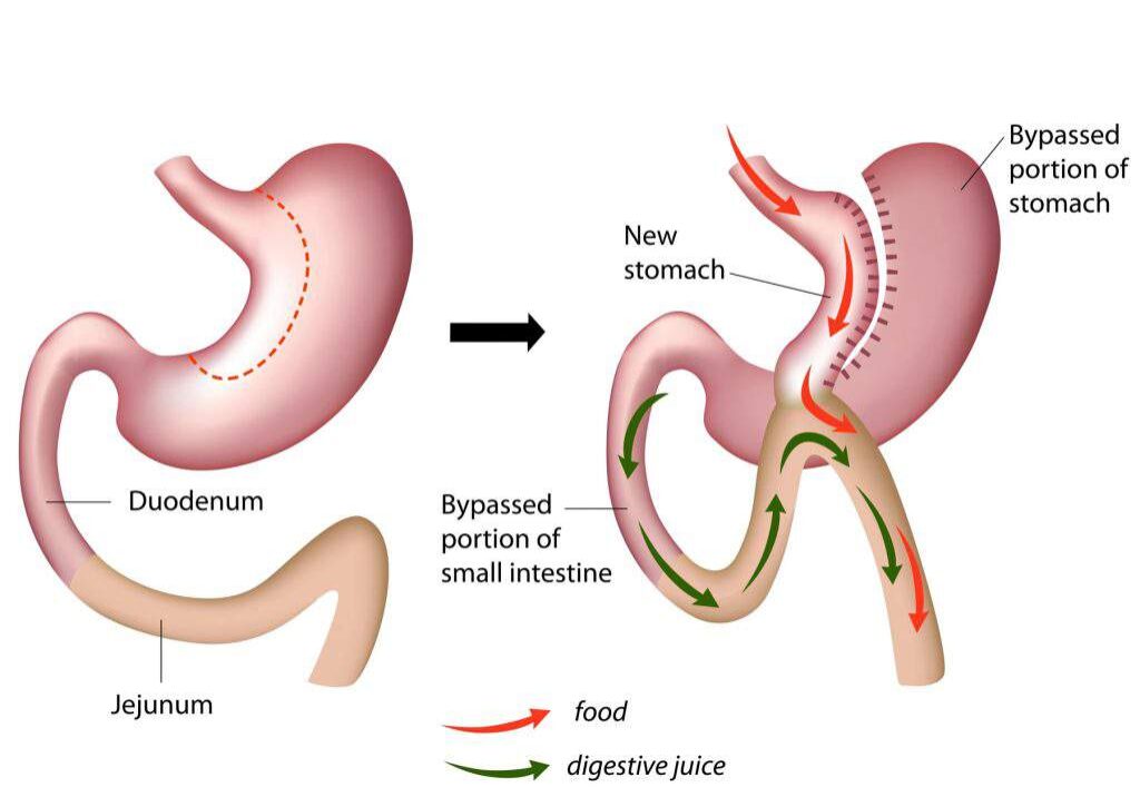 Laparoscopic Mini Gastric Bypass / Omega Loop Bypass