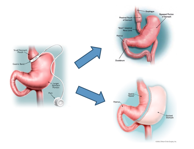 Laparoscopic Revisional/Redo Bariatric Surgery