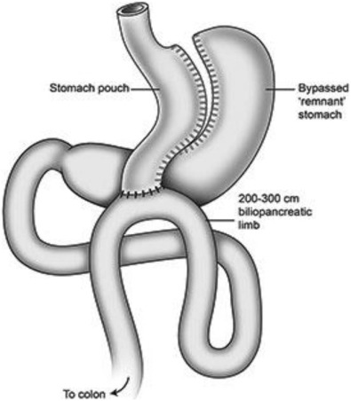 Laparoscopic Sleeve Gastrectomy With Duodenojejunostomy
