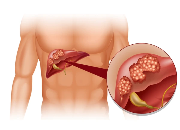 Liver Cancer Surgery