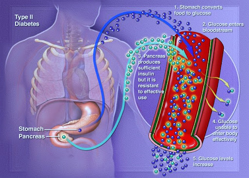 Metabolic Surgery For Diabetes