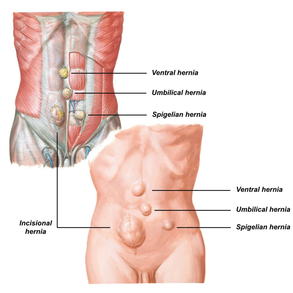 Open Hernia Surgery