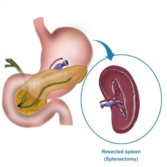 Laparoscopic Splenectomy 2
