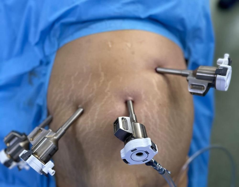 Laparoscopic Surgery