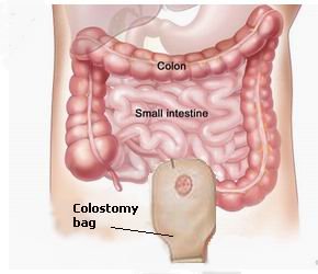 Abdominoperineal Resection
