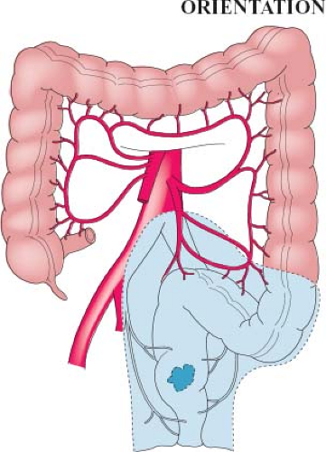 Abdominoperineal Resection