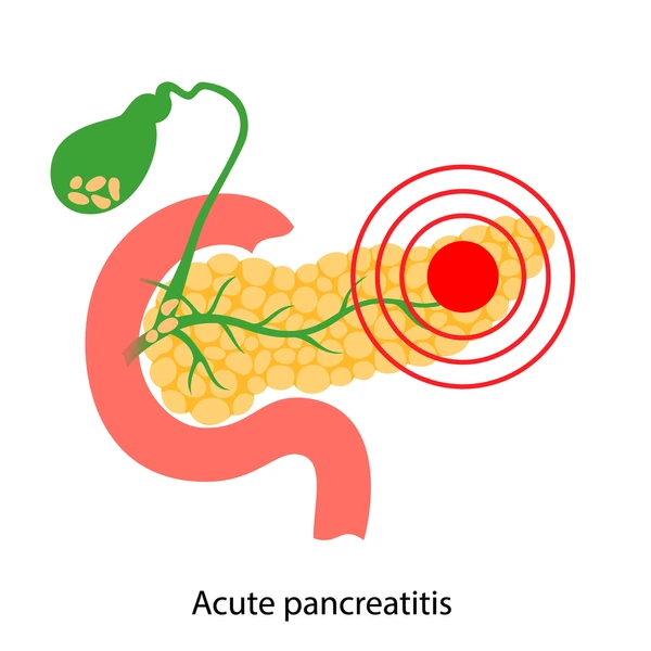 Acute Pancreatitis