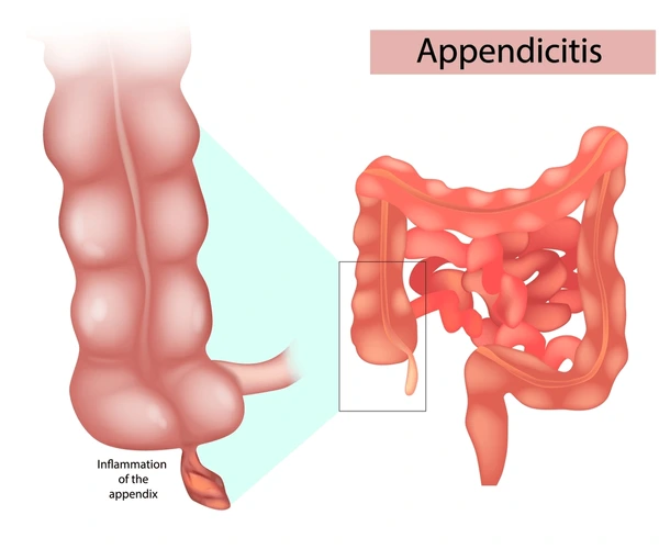 Appendix Removal Surgery