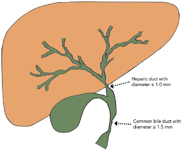 Biliary Stricture