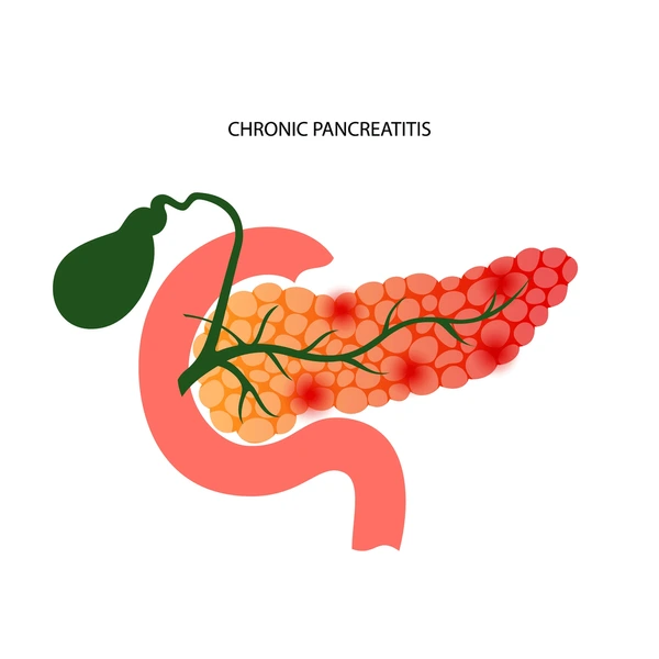 Chronic Pancreatitis