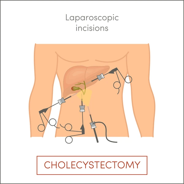 Gall Bladder Removal Surgery