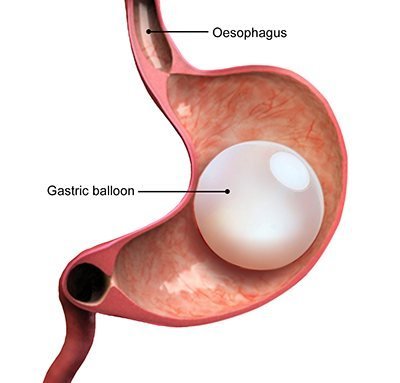 Intra Gastric Balloon Insection