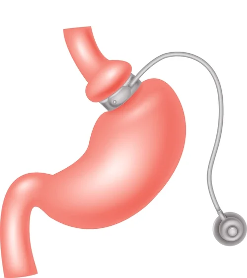 Laparoscopic Adjustable Gastric Banding