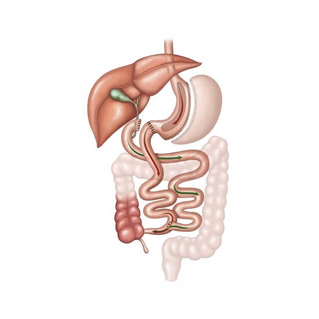 Laparoscopic Duodenal Switch