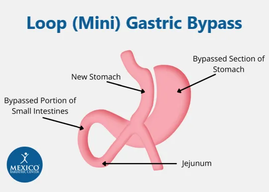 Laparoscopic Mini Gastric Bypass / Omega Loop Bypass