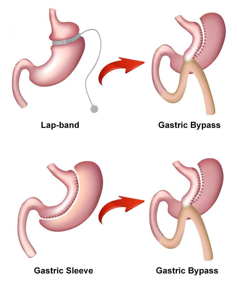 Laparoscopic Revisional/redo Bariatric Surgery
