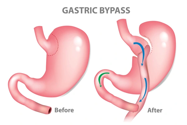 Laparoscopic Banded Roux-en Y Gastric Bypass