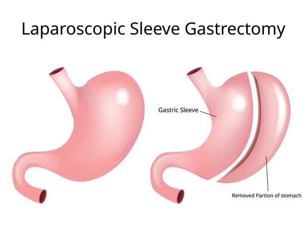 Laparoscopic Sleeve Gastrectomy