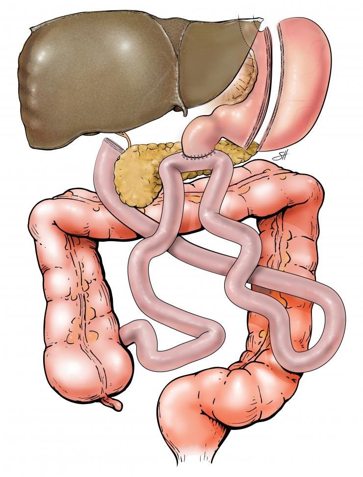 Laparoscopic Sleeve Gastrectomy With Duodeno Ileostomy