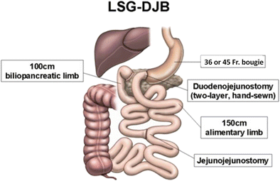 Laparoscopic Sleeve Gastrectomy With Duodeno-jejunostomy