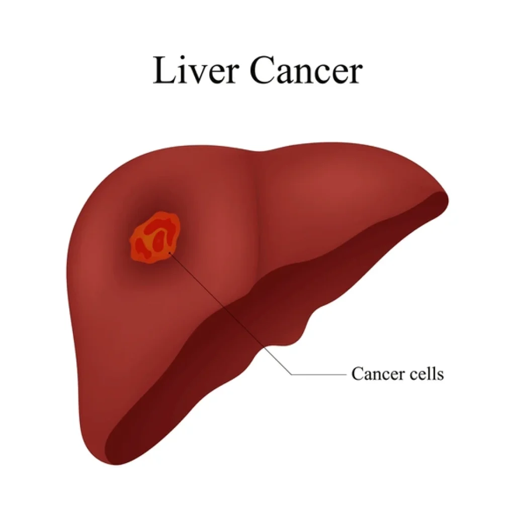 Liver Cancer Surgery