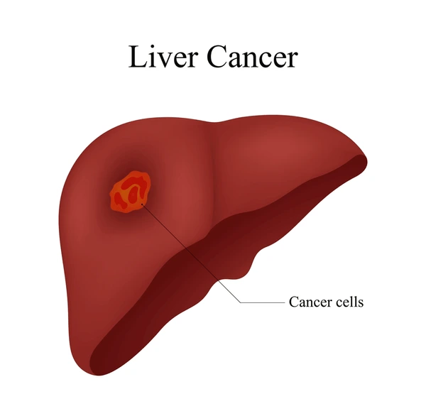 Liver Cancer Surgery