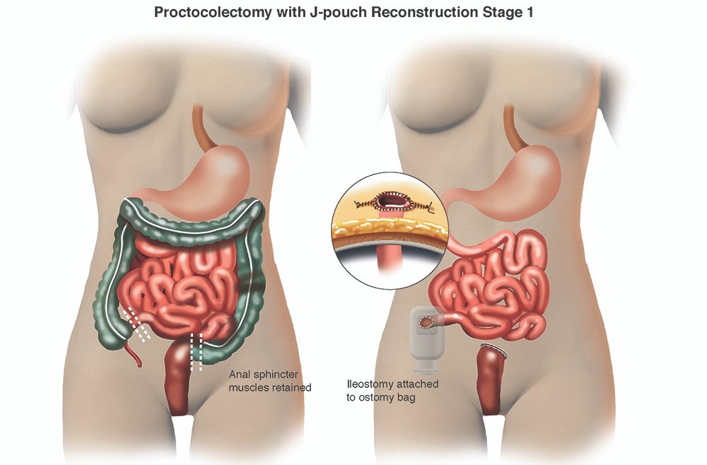 Total Proctocolectomy