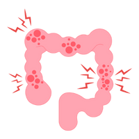 Colon Cancer