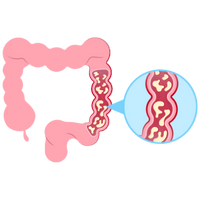 Crohn’s Disease