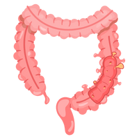 Diverticulitis