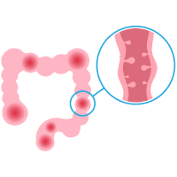 Benign Polyps