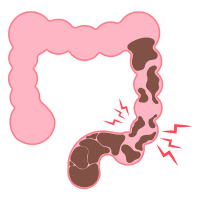 Intestinal Obstruction