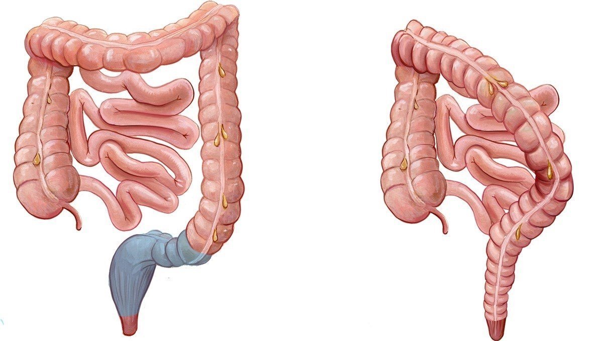 Anterior Resection - Dr. Jenit Gandhi