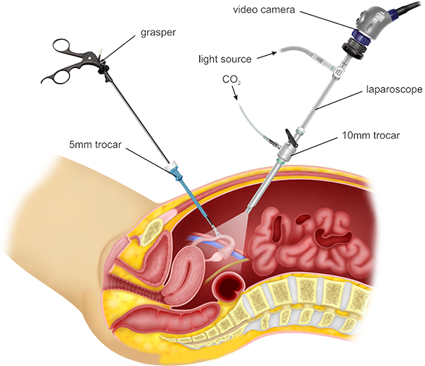 Diagnostic Laparoscopy