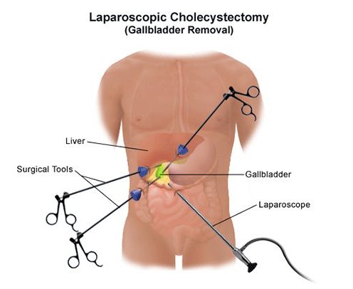 Gallbladder Removal Surgery