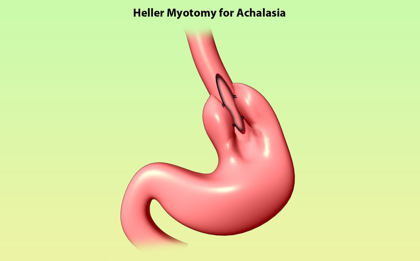 Laparoscopy Heller's Myotomy