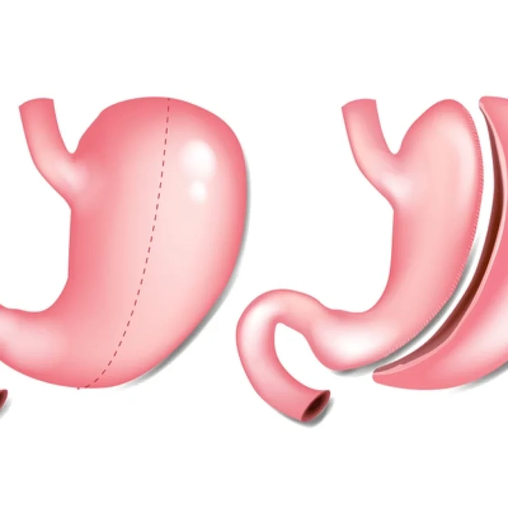 Single Incision Sleeve Gastrectomy