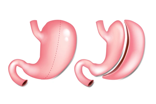 Single Incision Sleeve Gastrectomy