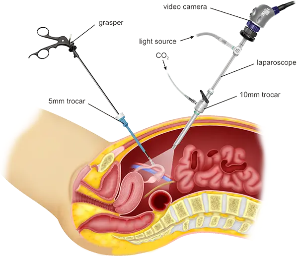 Laproscopy Diagram