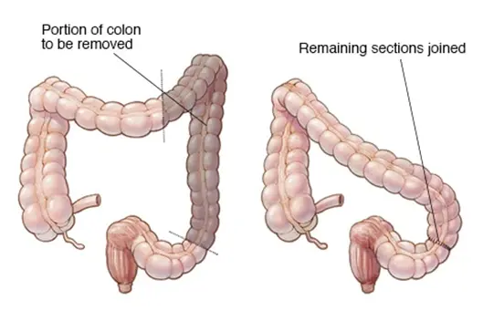 Left Hemi-Colectomy
