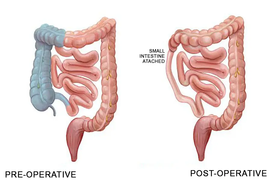 Right Hemi Colectomy